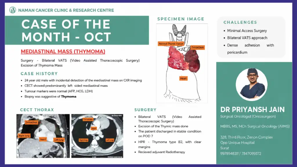Bilateral VATS Surgery for Thymoma treatment in Surat