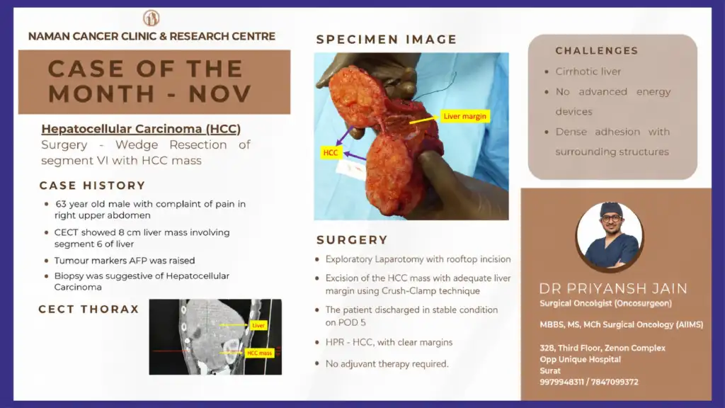 Hepatocellular Carcinoma Surgery for Liver Tumour Removal in Cirrhotic Liver