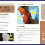 Hepatocellular Carcinoma Surgery for Liver Tumour Removal in Cirrhotic Liver