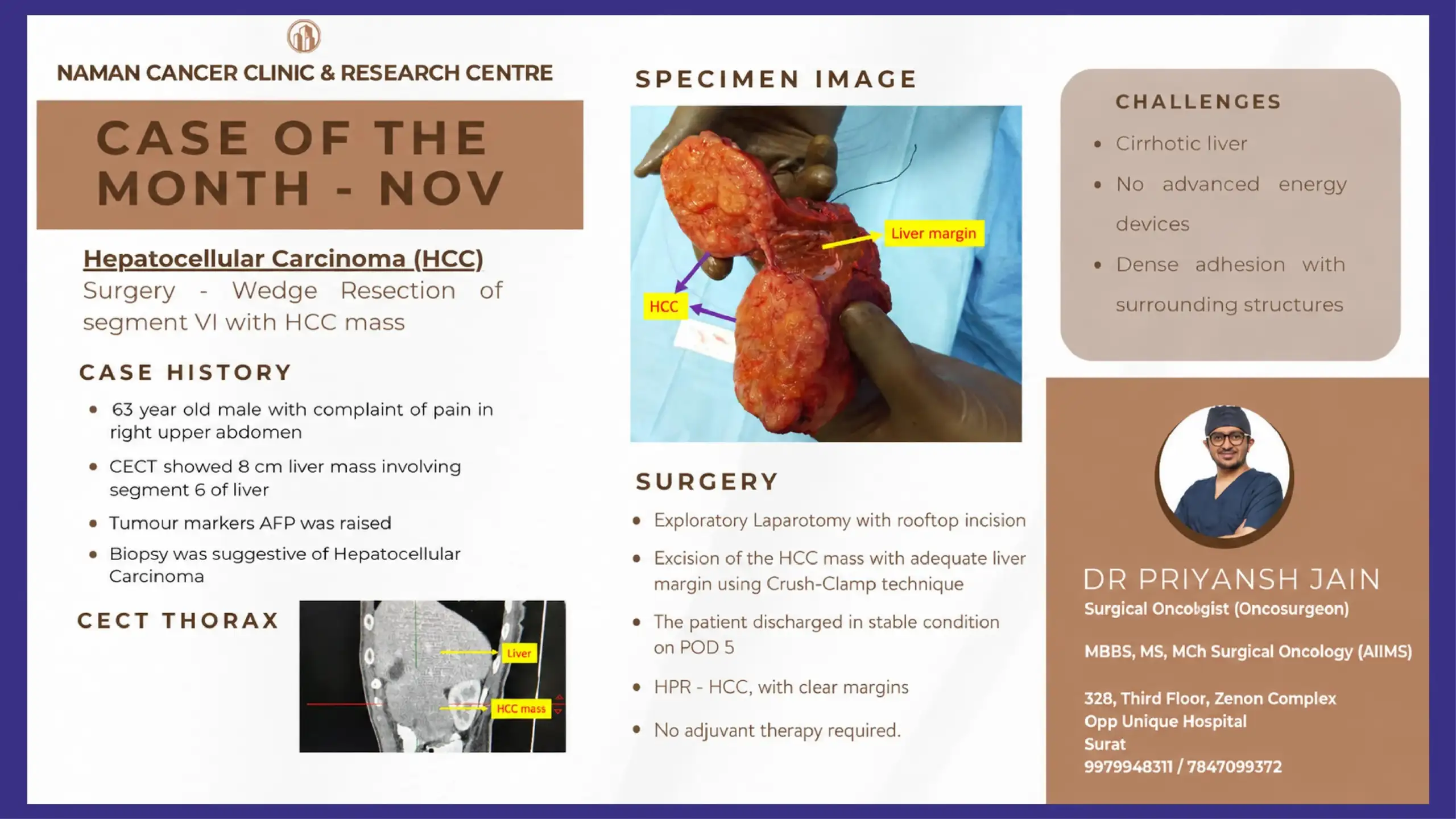 Hepatocellular Carcinoma Surgery for Liver Tumour Removal in Cirrhotic Liver