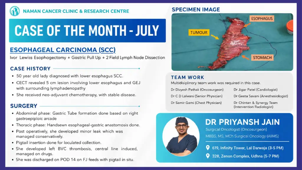 Esophageal Carcinoma Surgery with Ivor Lewis Esophagectomy