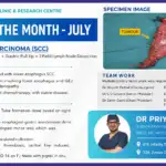 Esophageal Carcinoma Surgery with Ivor Lewis Esophagectomy
