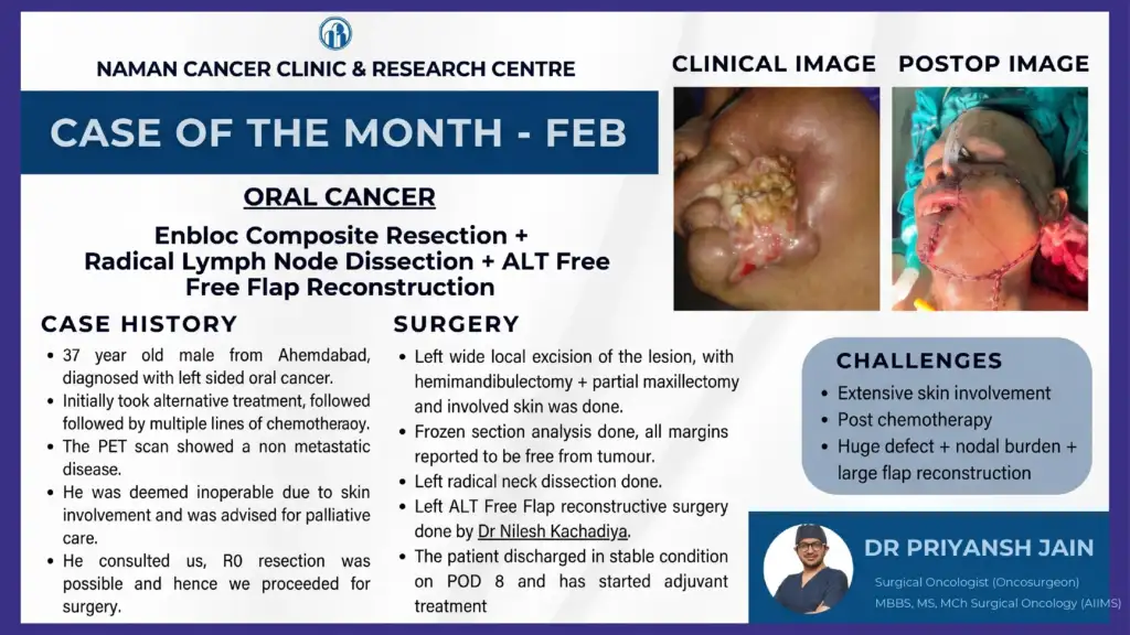 Advanced Oral Cancer Surgery with ALT Free Flap Reconstruction by Dr Priyansh Jain