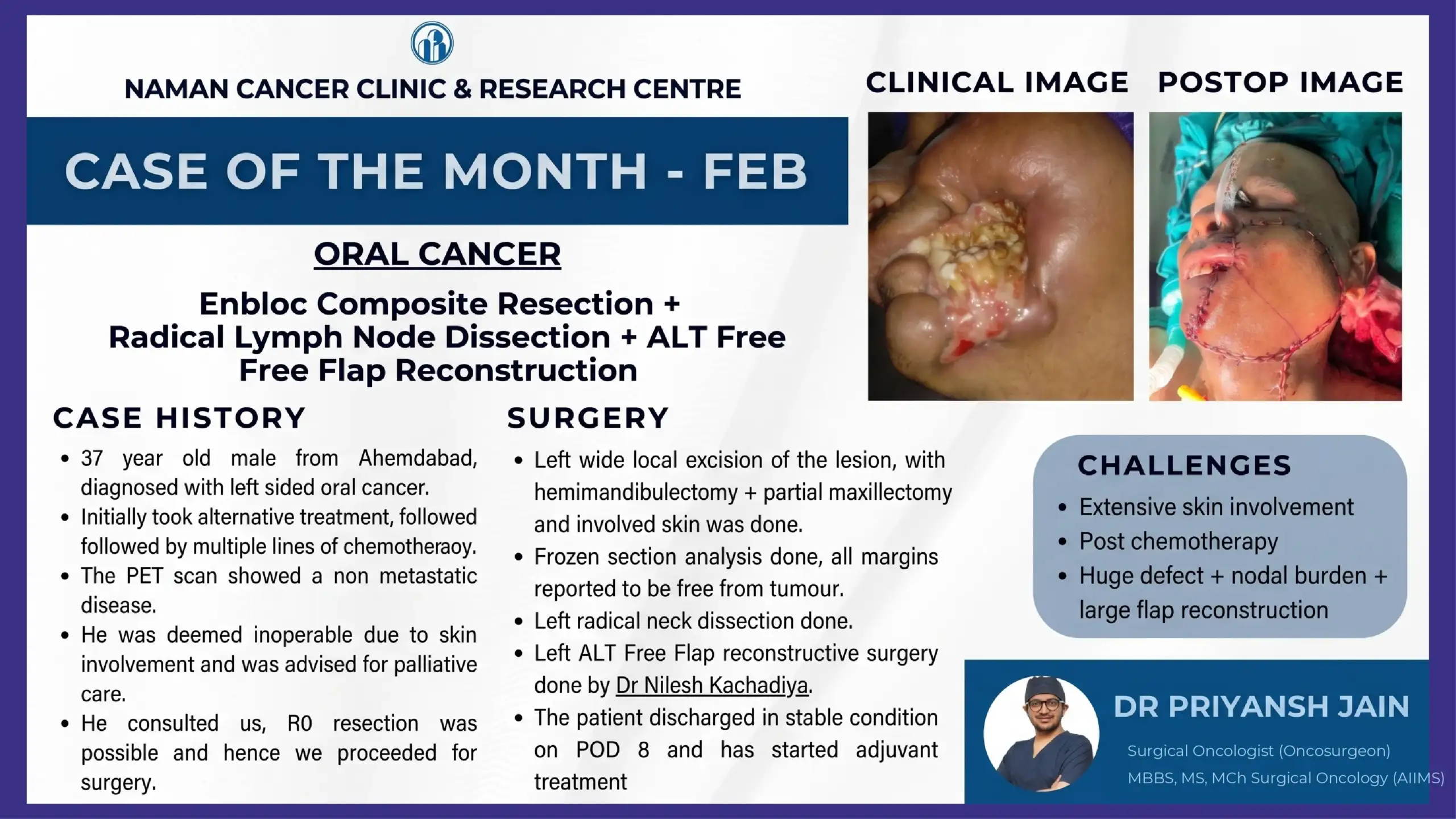 Advanced Oral Cancer Surgery with ALT Free Flap Reconstruction by Dr Priyansh Jain