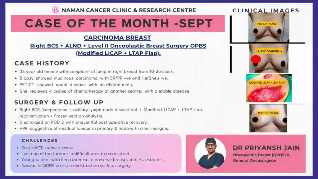 Advanced Oncoplastic Breast Surgery with LICAP and LTAP Flaps