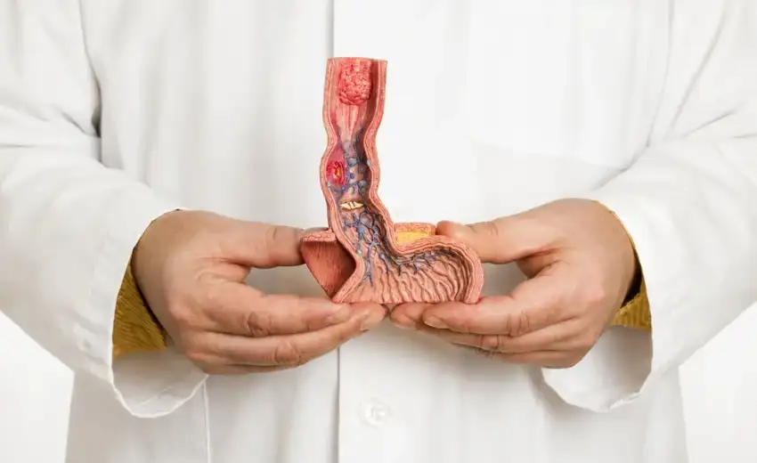 Esophageal Carcinoma Surgery with Ivor Lewis Esophagectomy
