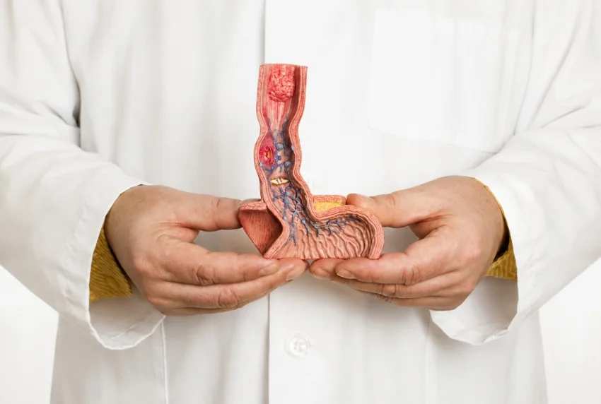 Esophageal Carcinoma Surgery with Ivor Lewis Esophagectomy
