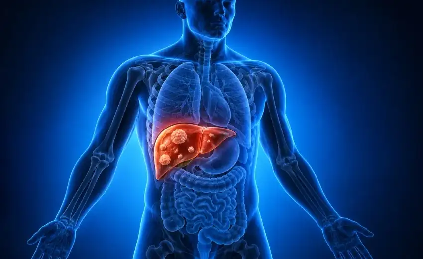 Liver Metastasis
